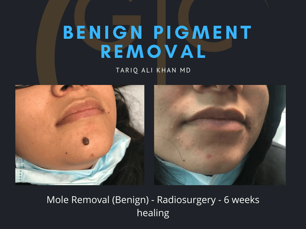 Gentle Care Laser Tustin Before and After picture - Mole Removal